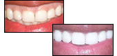 Gingival Reshaping